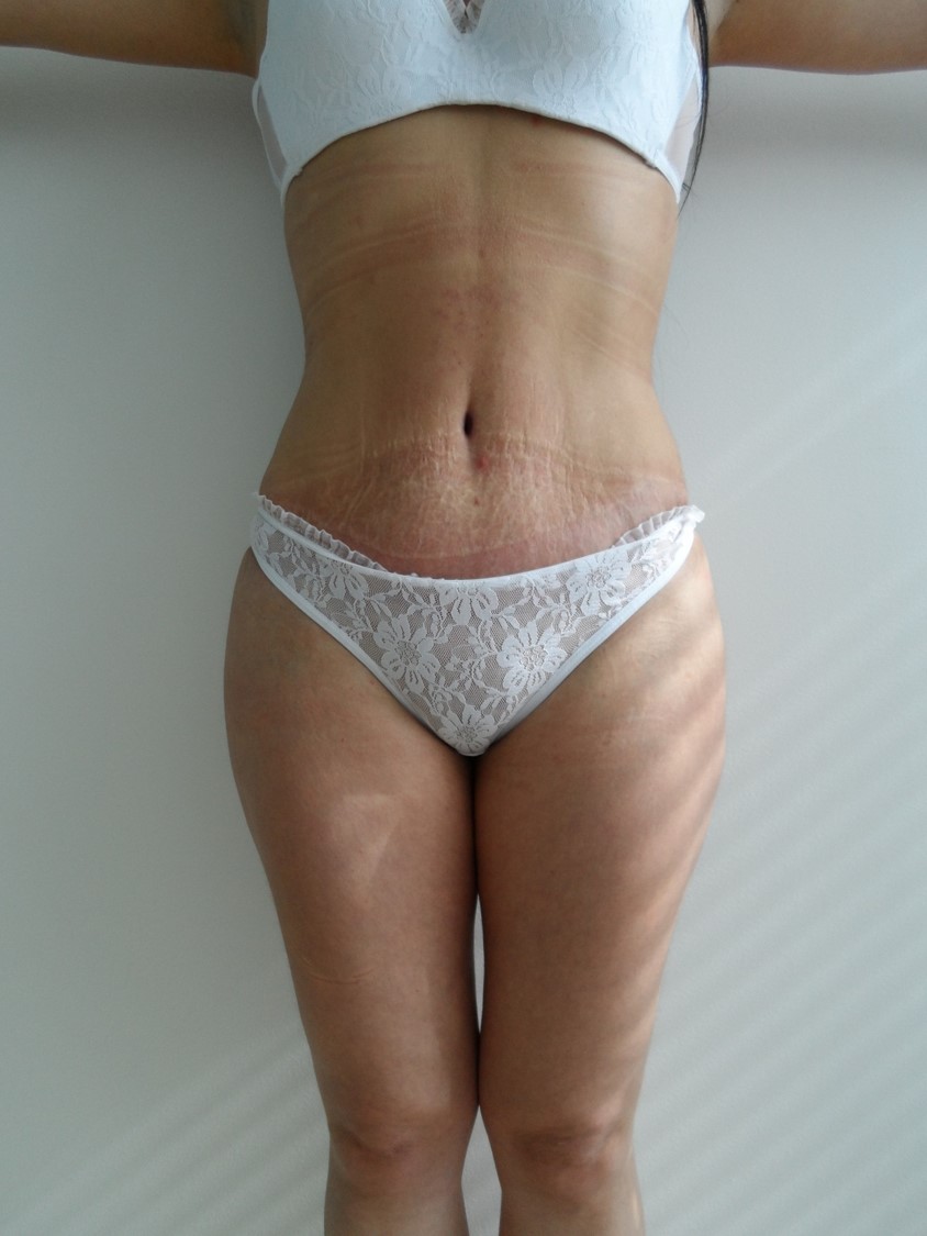 LIPOLIPECTOMIA 3 POST