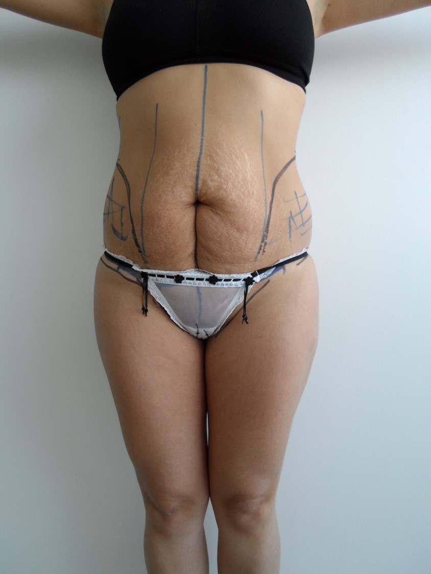 LIPOLIPECTOMIA 3 PRE