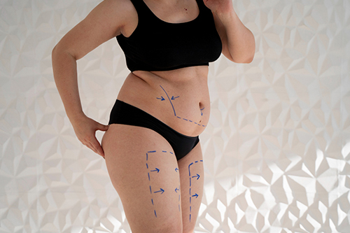 img-cual-es-la-diferencia-entre-liposuccion-y-lipoescultura-3 Mujer con exceso de grasa, paciente de lipoescultura y liposucción.