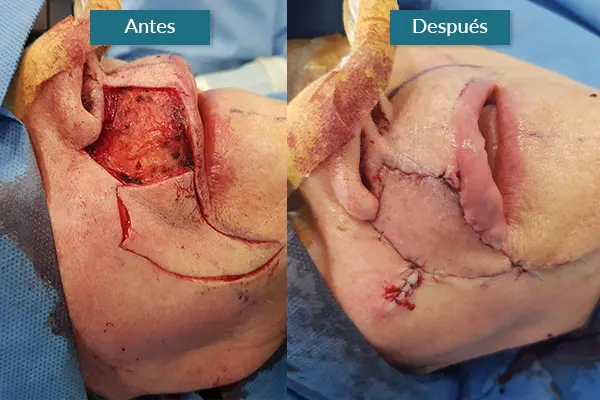Img-CarlosCamachoCirujano-Antes&Después-cirugía reconstructiva de labios por tumor Img-CarlosCamachoCirujano-Antes&Después-cirugía reconstructiva de labios por tumor