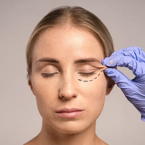 img-blefaroplastia-bogota-1