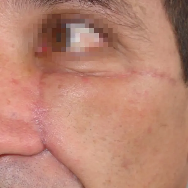 img-cirugia-de-cancer-de-piel-en-la-cara-1