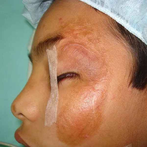 img-cirugia-reconstructiva-cicatrices-1