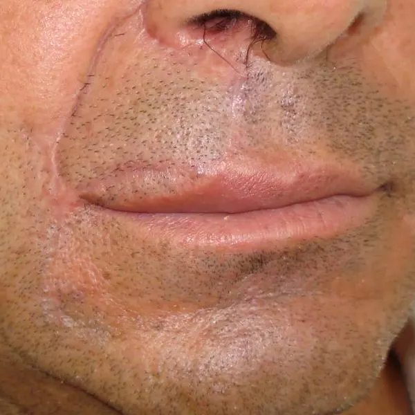 img-lip-reconstruction-bogota-1