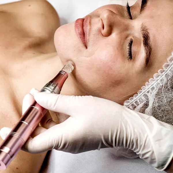 img-peeling-facial-bogota-1