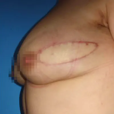 img-reconstruccion-de-seno-por-cancer-1-LCP