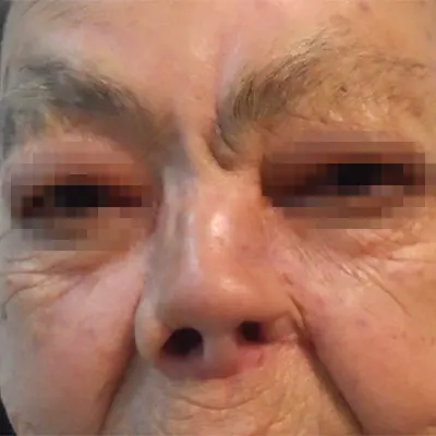 img-reconstruccion-nasal-total-1-LCP