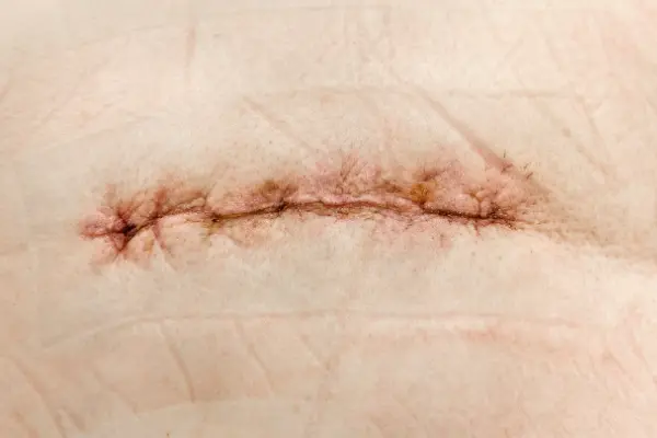 Las cicatrices son una consecuencia natural de la piel tras una lesión o cirugía. Muchos pacientes desean saber si se puede quitar una cicatriz con cirugía plástica​ para mejorar su...